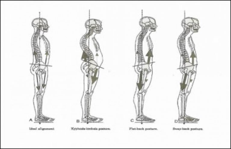 Dancer Health: Hyperextension of the Knees