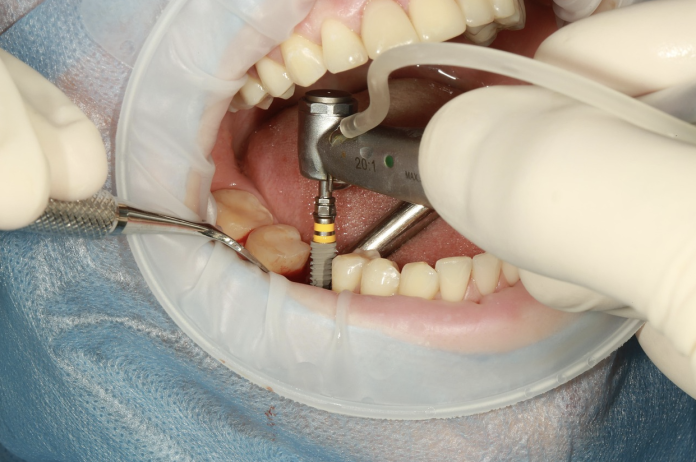 Dentist placing a dental implant into the jawbone during an implant procedure following treatment planning and consul