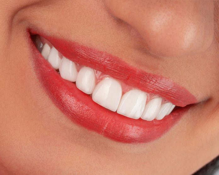kamal-hoseinianzade-KzmhiJJ041M-unsplash Close-up of porcelain cosmetic veneers creating a bright, natural-looking smile with healthy gums and evenly shaped teeth.