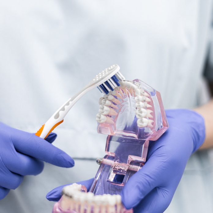 Demonstration of the proper way to clean clear aligners using a soft toothbrush and a dental model.